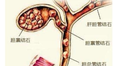 膽囊結(jié)石可以不切膽嗎？