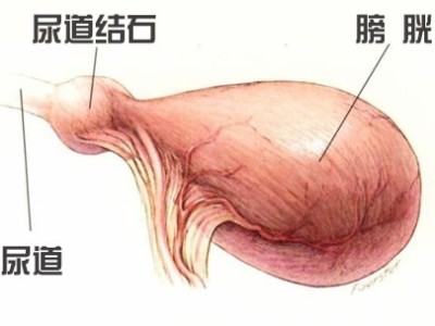 尿道結(jié)石